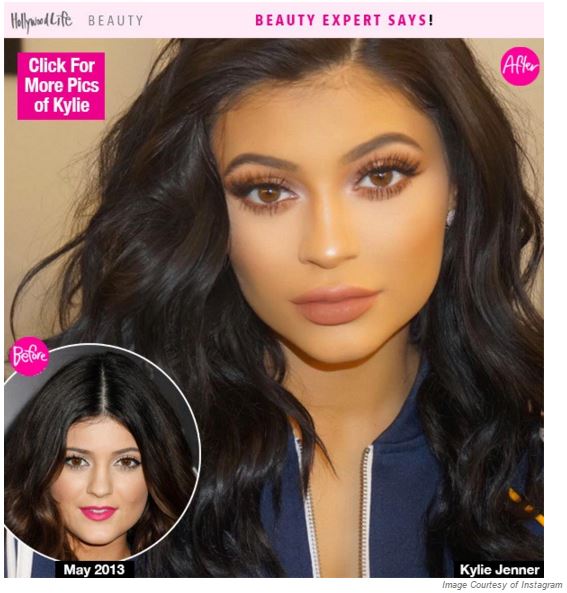 Kylie-Jenner-Lip-Augmentation