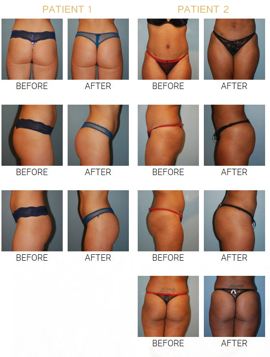 Butt Lift Procedure 50