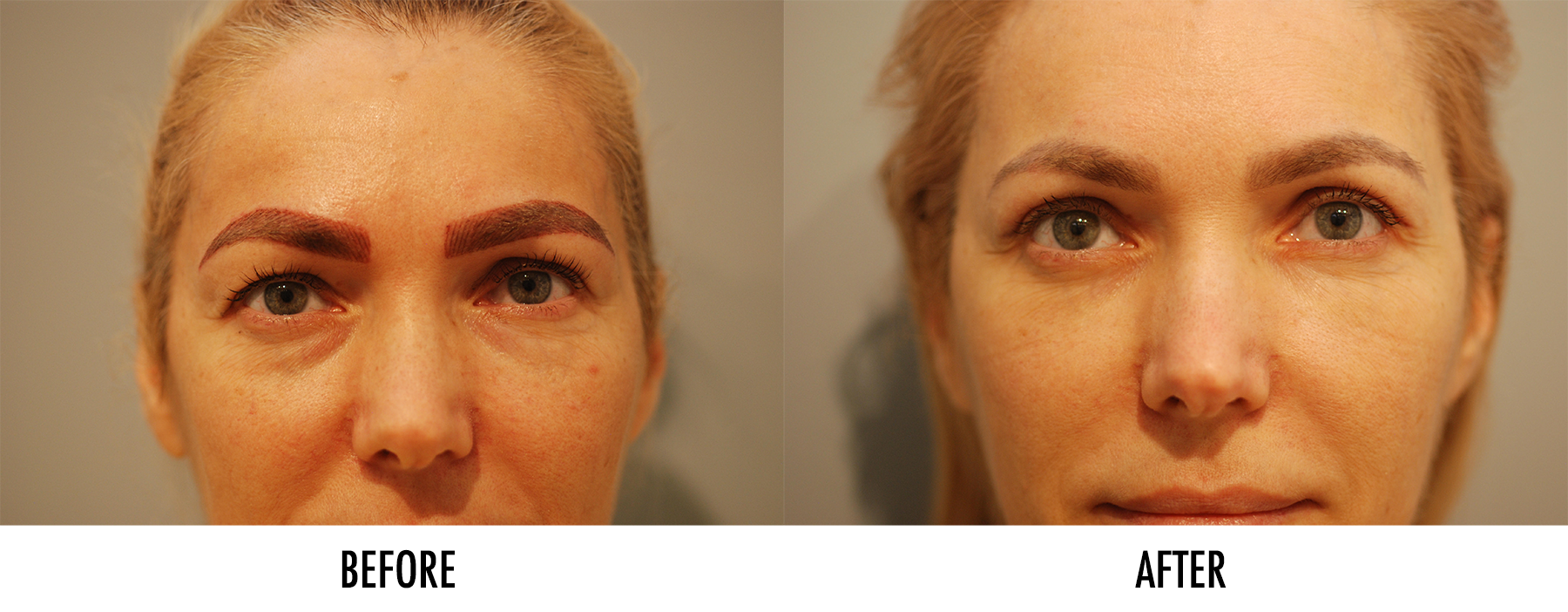 Eyelid Surgery / Blepharoplasty Before & After Pictures