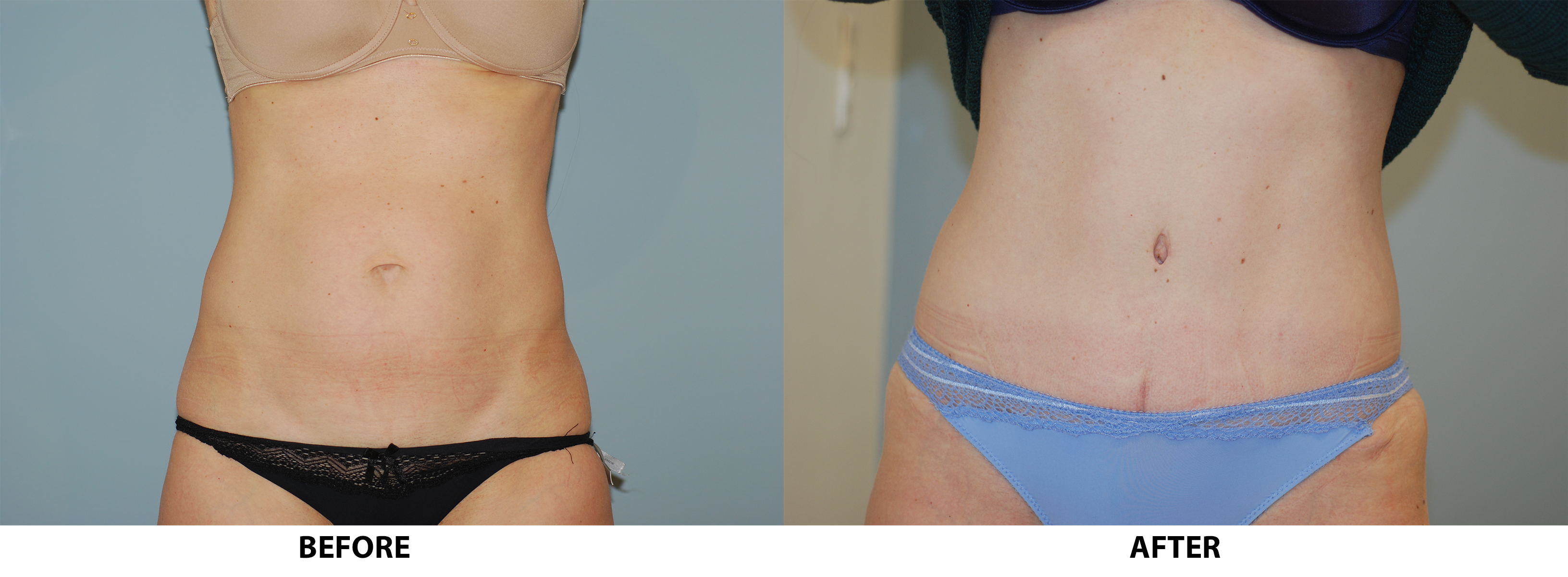 Before & After Pictures of Tummy Tuck  Tummy Tuck Specialist Specialist  Brooklyn - Tummy Tuck Specialist Specialist Farragut - Tummy Tuck  Specialist Specialist Canarsie - Tummy Tuck Specialist Specialist Brooklyn  Heights 