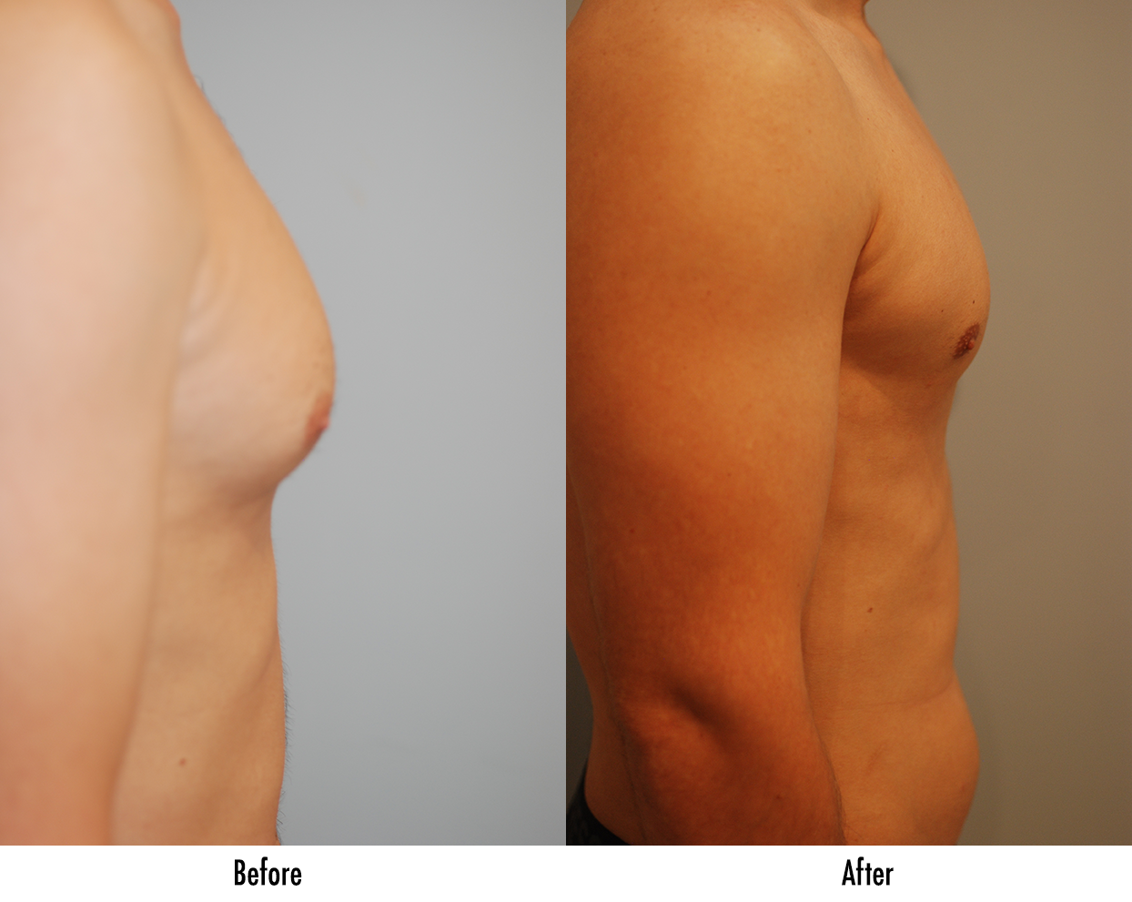 Doing Something About “Man Boobs” - Plastic Surgery in Grand