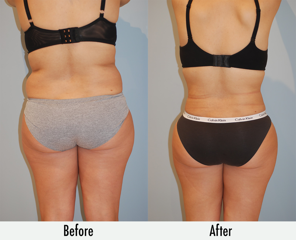 Smartlipo of the Back - Flanks, Bra Rolls, and Neck Humps