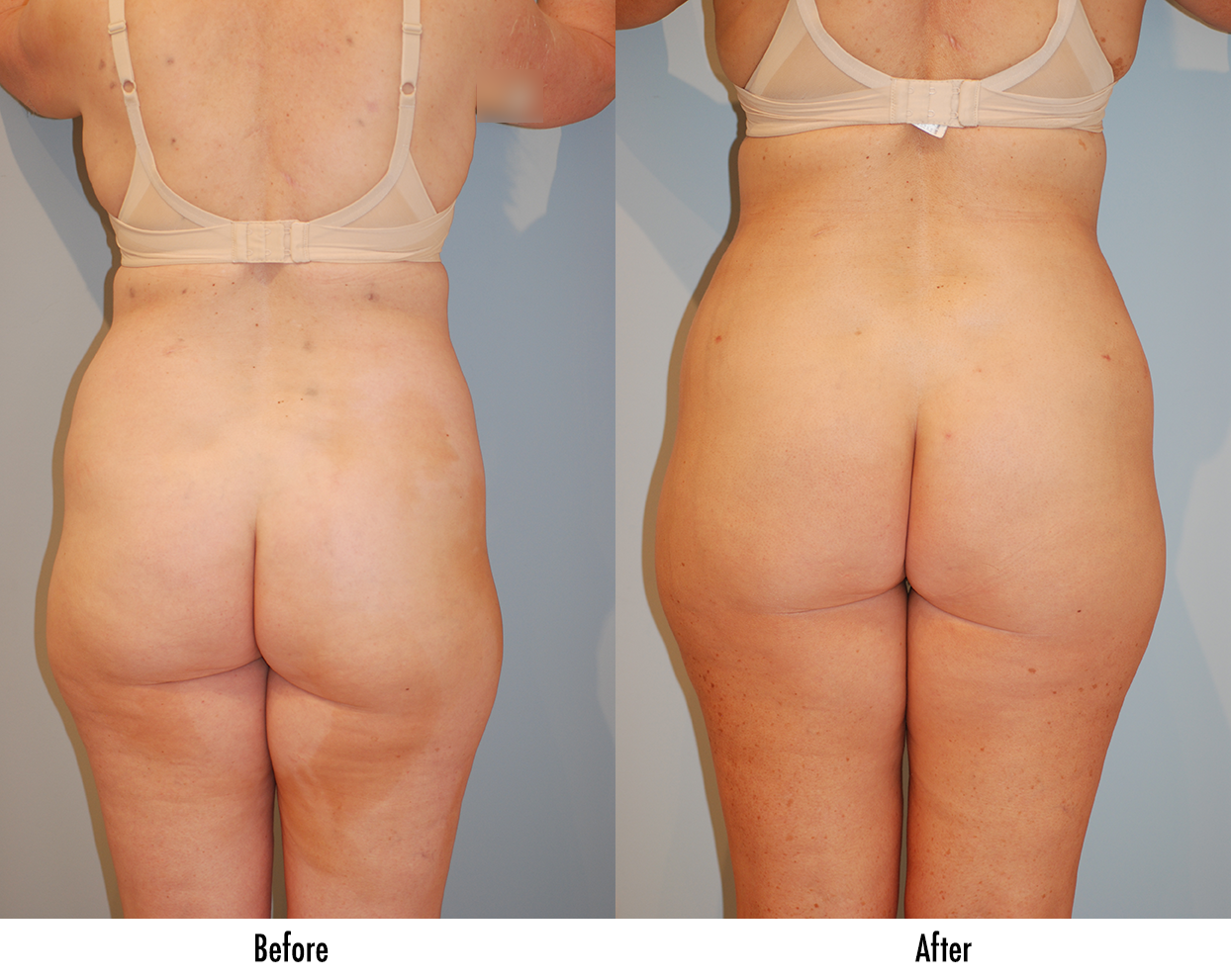 Liposuction Specialist Rockefeller Center