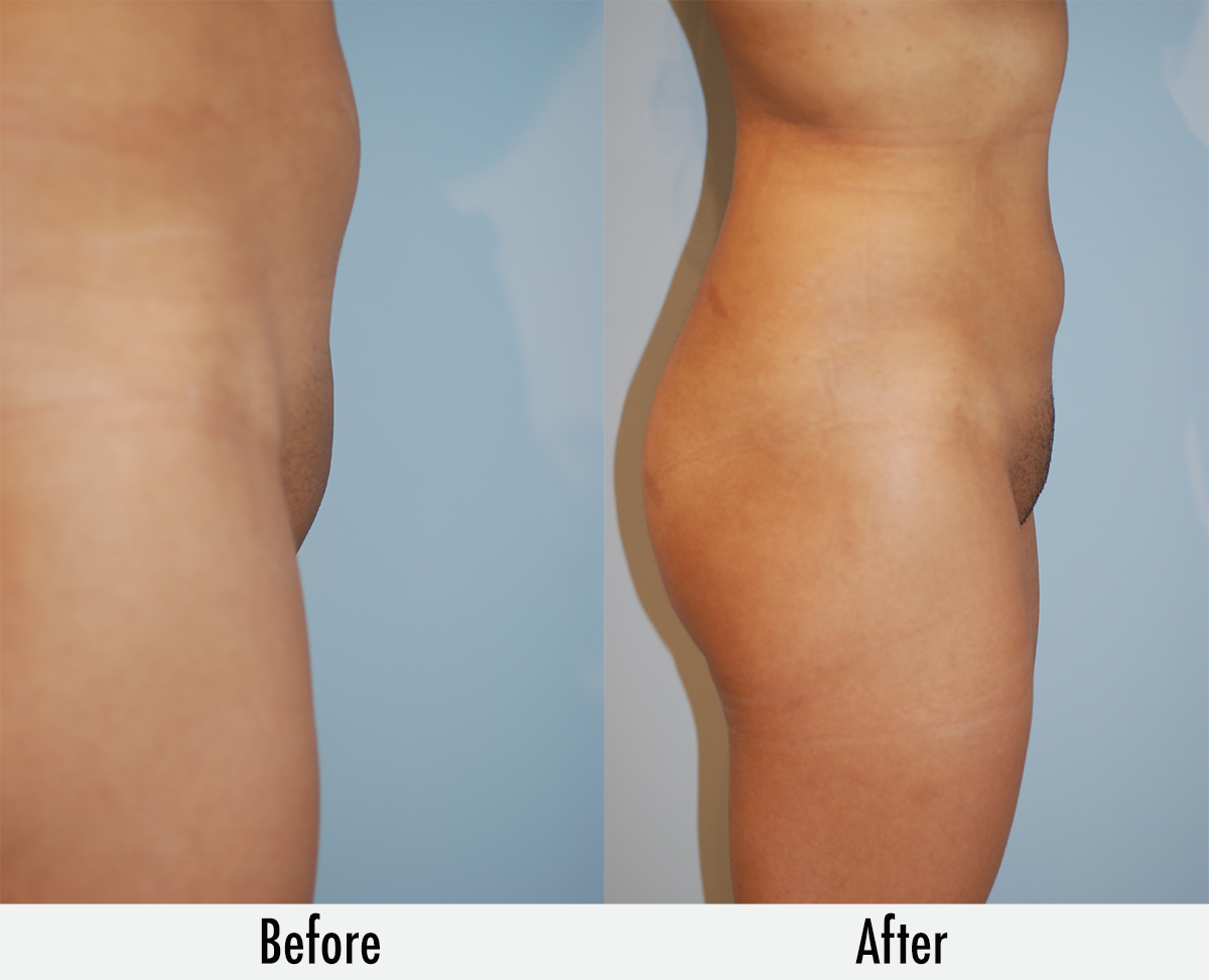 Arm Liposuction NYC  Sculpt Toned Arms Professionally