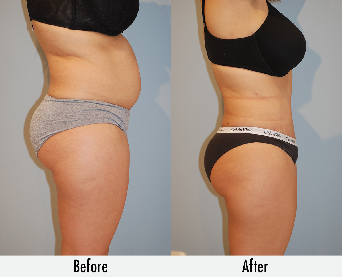 scarless tummy tuck before and after in Midtown East Manhattan NYC