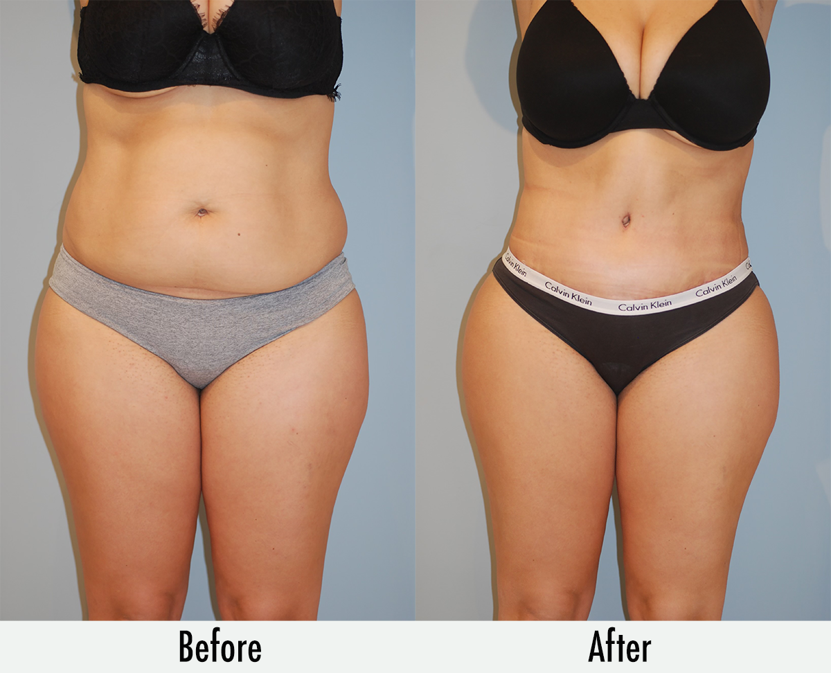 Awake Liposuction: The I was there Moment of Transformation