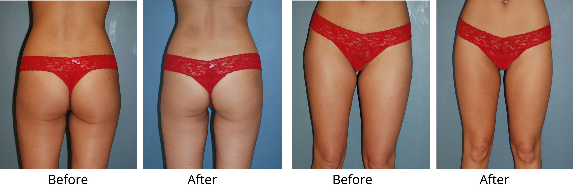 Brazilian Butt Lift Before and After Photo Gallery, Fort Worth, Texas