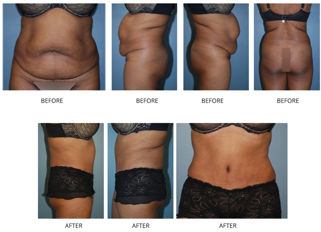 Tummy Tuck in NYC  Tummy Tuck Surgery for Women