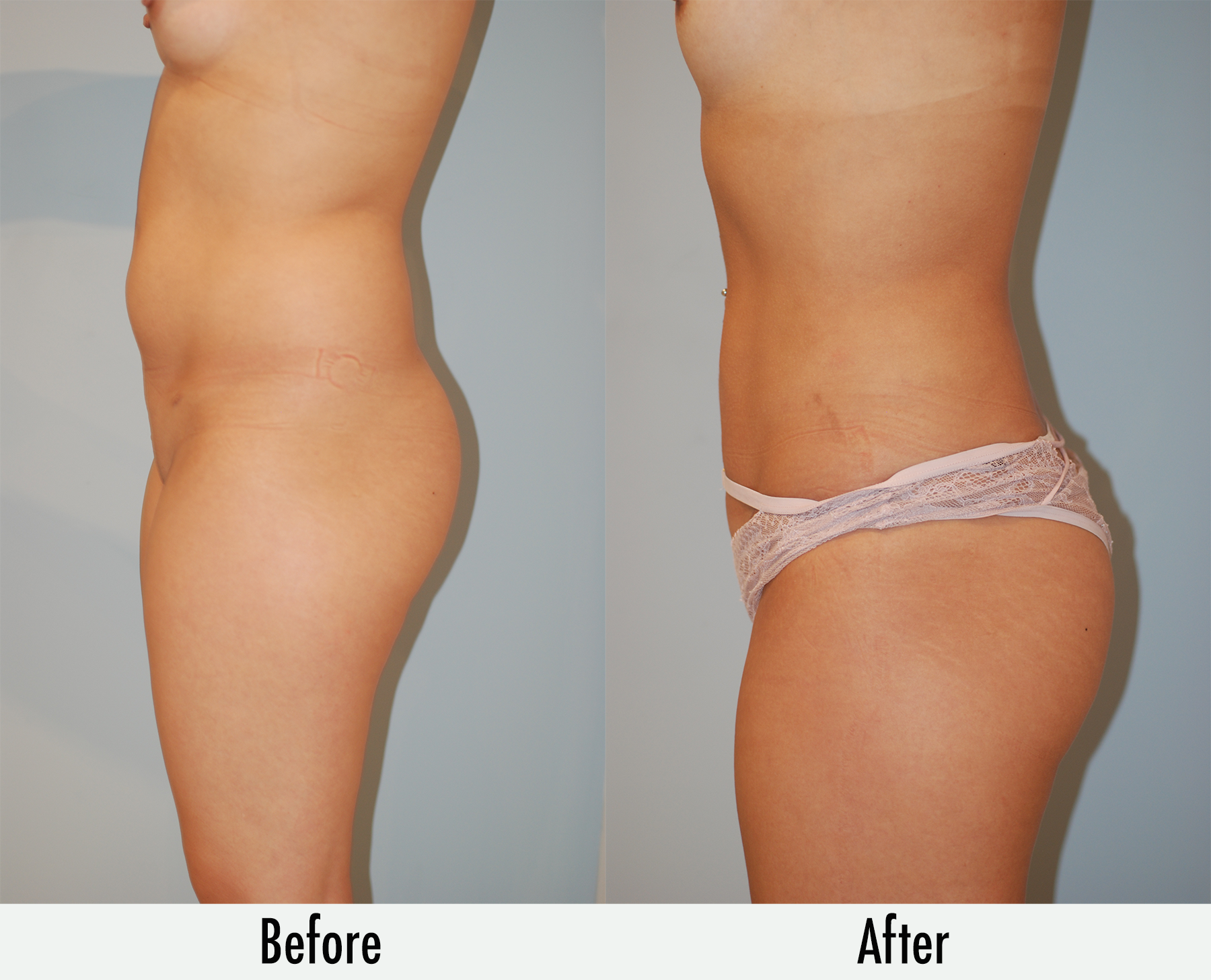 Hips liposuction: cost, procedure and results before and after