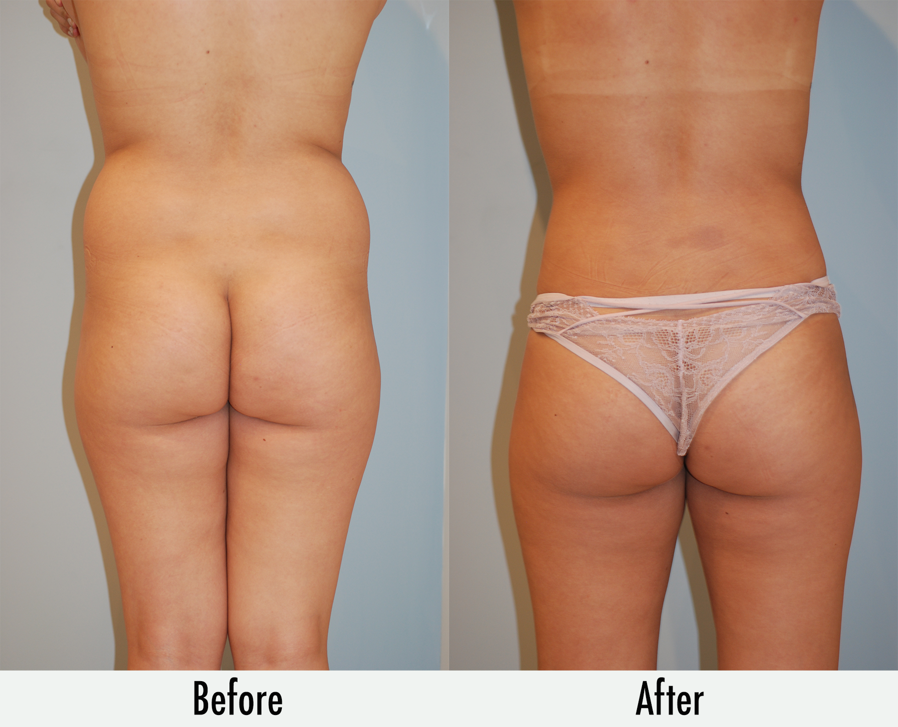 Tummy Tuck or Liposuction: Which Is the Better Solution for Your Muffin  Top?: Best Impression Med Spa: Medical Spa