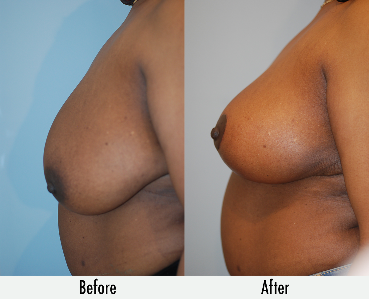 Before & After Pictures Of Breast Lift In Manhattan, NYC – Breast Lift  Specialist Brooklyn - Breast Lift Specialist Farragut - Breast Lift  Specialist Canarsie - Breast Lift Specialist Brooklyn Heights -