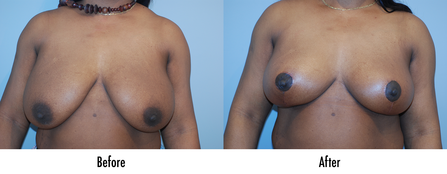 Before & After Pictures Of Breast Lift In Manhattan, NYC – Breast Lift  Specialist Brooklyn - Breast Lift Specialist Farragut - Breast Lift  Specialist Canarsie - Breast Lift Specialist Brooklyn Heights -