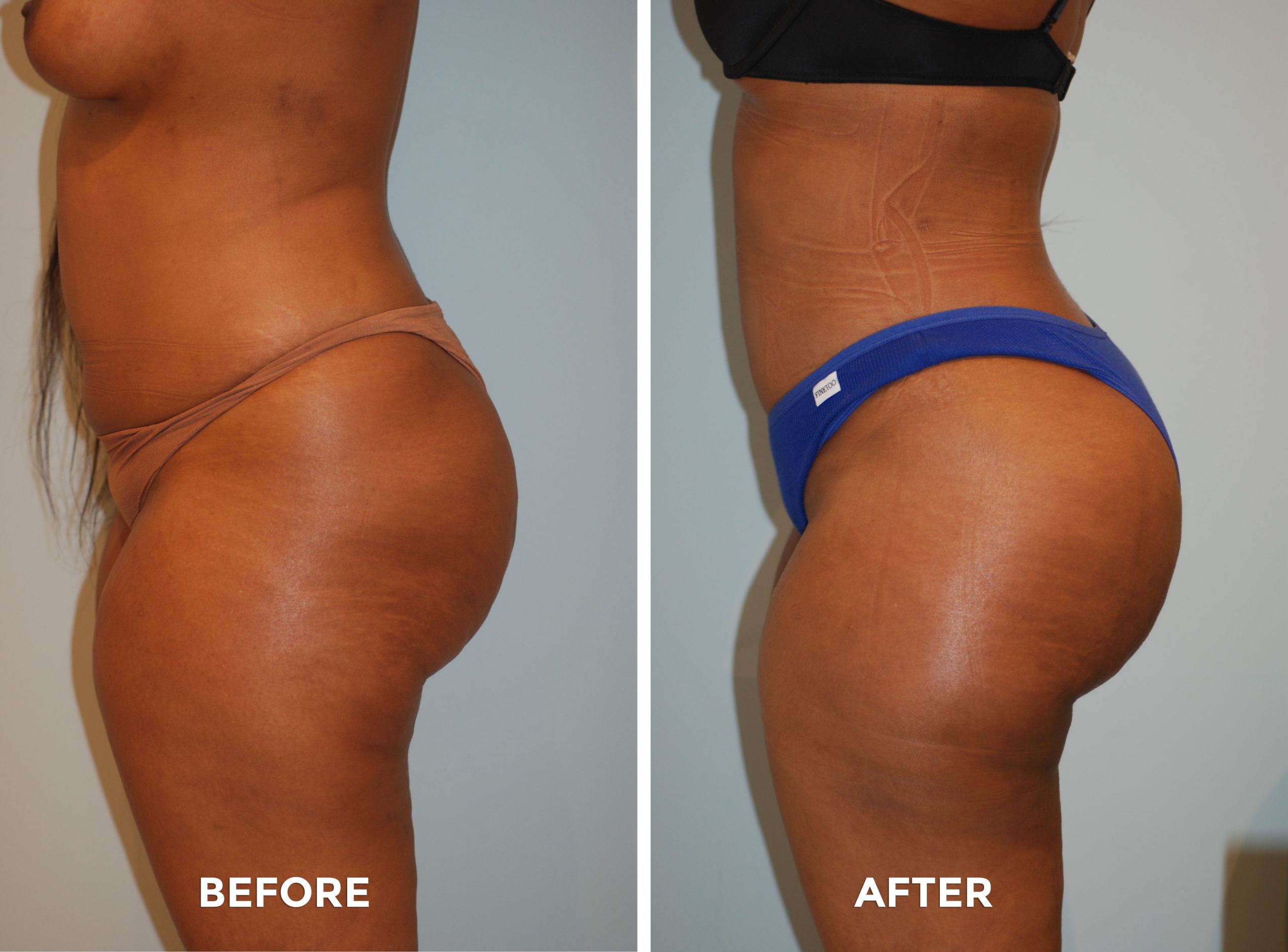 Brazilian Butt Lift | Brazilian Butt Lift Procedure New York | Brazilian  Butt Lift Specialist Brooklyn - Brazilian Butt Lift Specialist Farragut -  Brazilian Butt Lift Specialist Canarsie - Brazilian Butt Lift