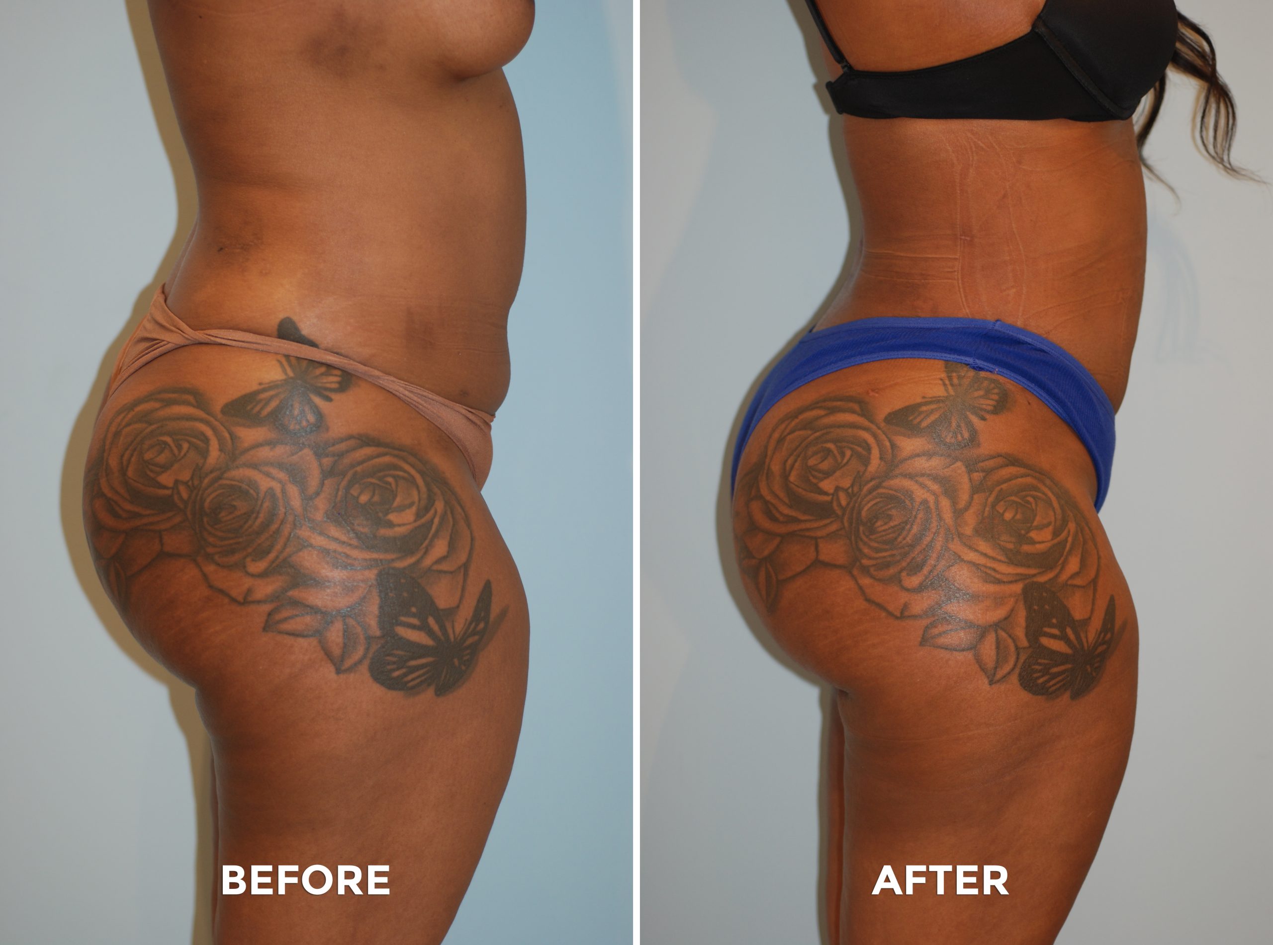 Brazilian Butt Lift | Brazilian Butt Lift Procedure New York | Brazilian  Butt Lift Specialist Brooklyn - Brazilian Butt Lift Specialist Farragut -  Brazilian Butt Lift Specialist Canarsie - Brazilian Butt Lift