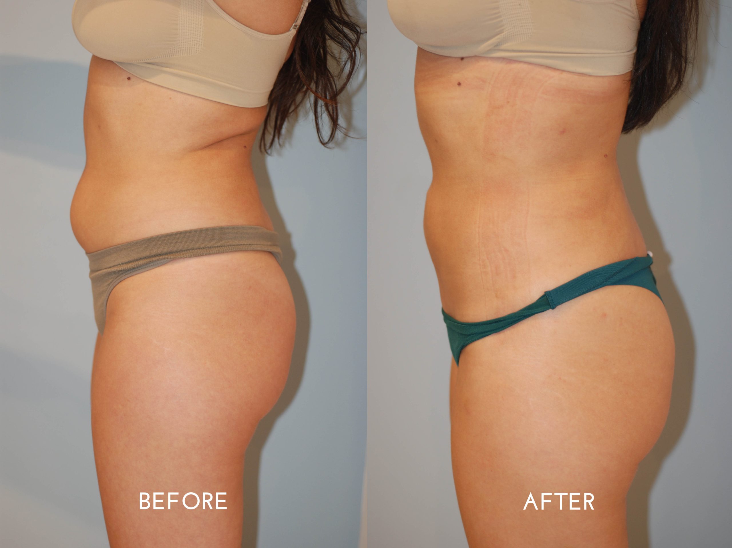 Liposuction Specialist Rockefeller Center | Liposuction Specialist Diamond  District | Liposuction Specialist Specialist Brooklyn - Liposuction  Specialist Specialist Farragut - Liposuction Specialist Specialist Canarsie  - Liposuction Specialist ...